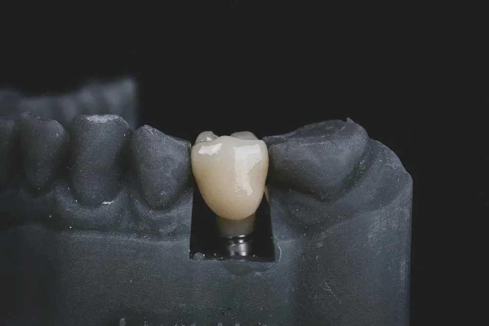 Replacing Missing Teeth in Bondi Junction — Dental Implants, Bridges and All-on-4