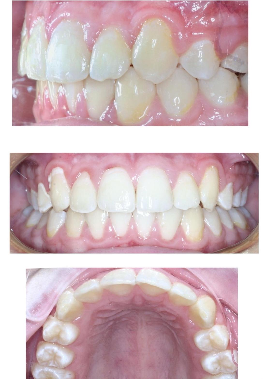 Braces Patient After | Dentist in the Park
