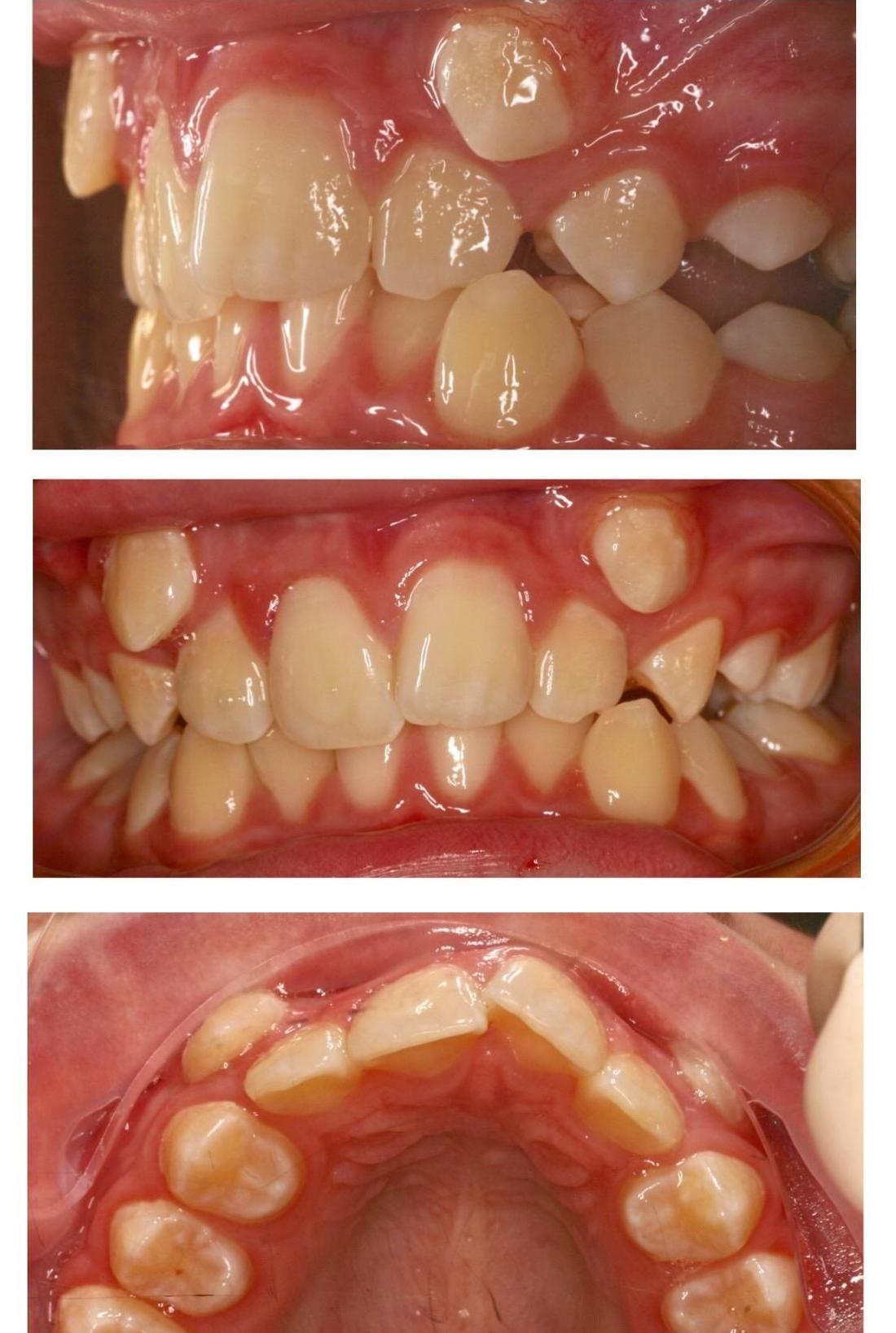 Braces Patient Before | Dentist in the Park