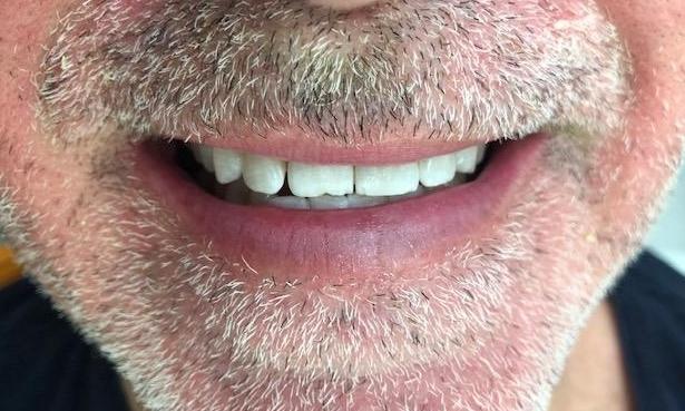 Teeth Whitening Patient After | Dentist in the Park