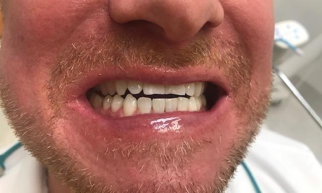 Teeth-Whitening-Before-and-After-Before-Image