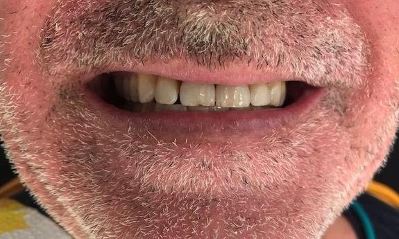 Teeth Whitening Patient Before | Dentist in the Park